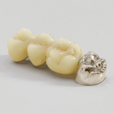 Jensen OVERTURE Dental High Noble White Alloy